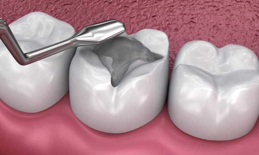 Maintain Your Dental Fillings With Expert Advice
