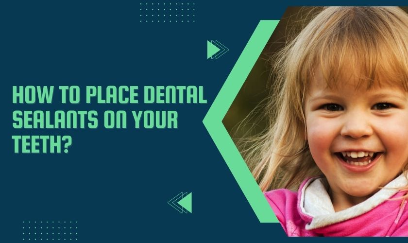 How To Place Dental Sealants On Your Teeth?