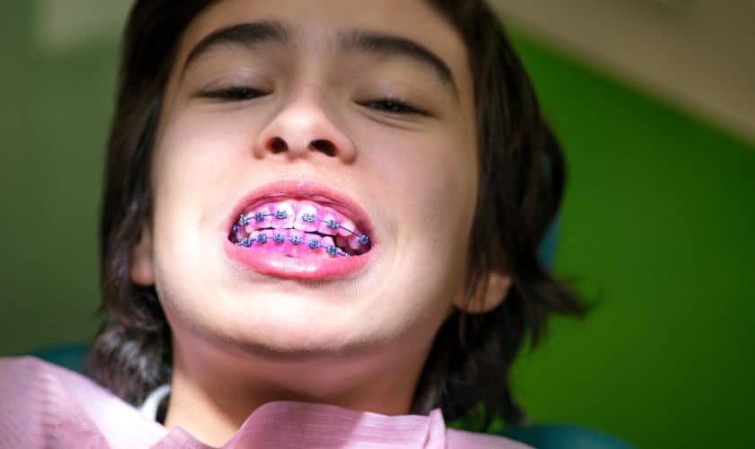 Featured image for “How Braces Can Improve Your Child’s Self-Esteem?”
