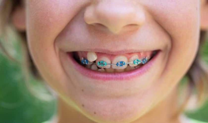 Featured image for “Shine Bright: A Kid’s Guide to Wearing Braces with Style”