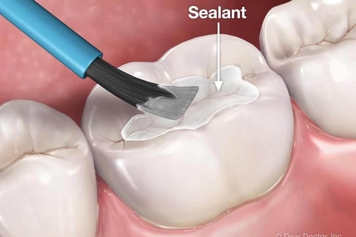 Featured image for “How to Prevent Cavities with Dental Sealants in Las Vegas”