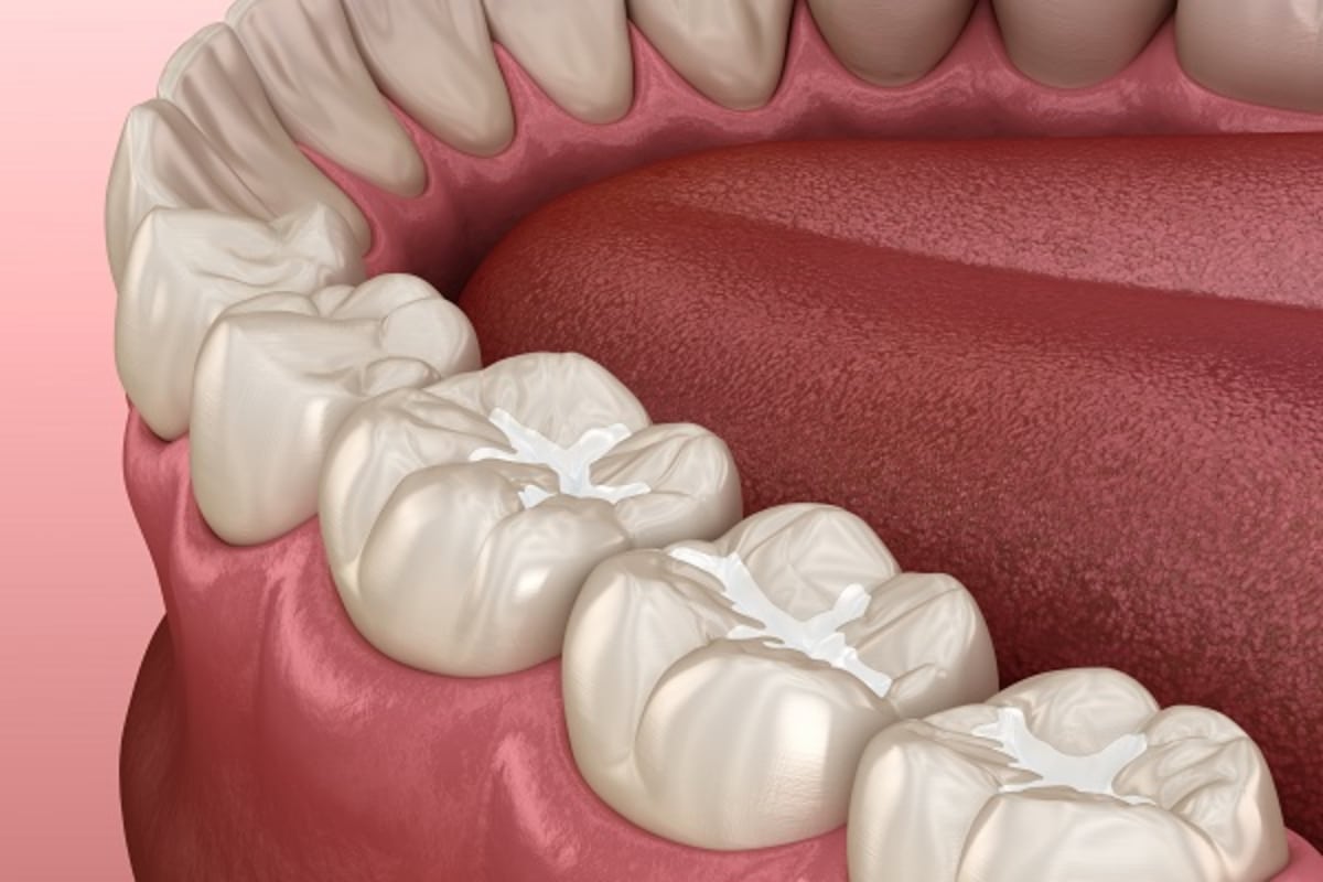 Featured image for “How to Prevent Tooth Decay with Dental Sealants”