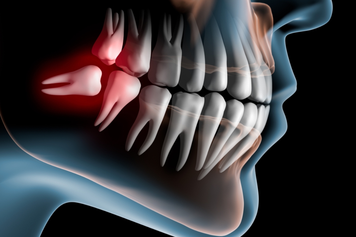 Featured image for “How to Prepare for Wisdom Teeth Removal?”