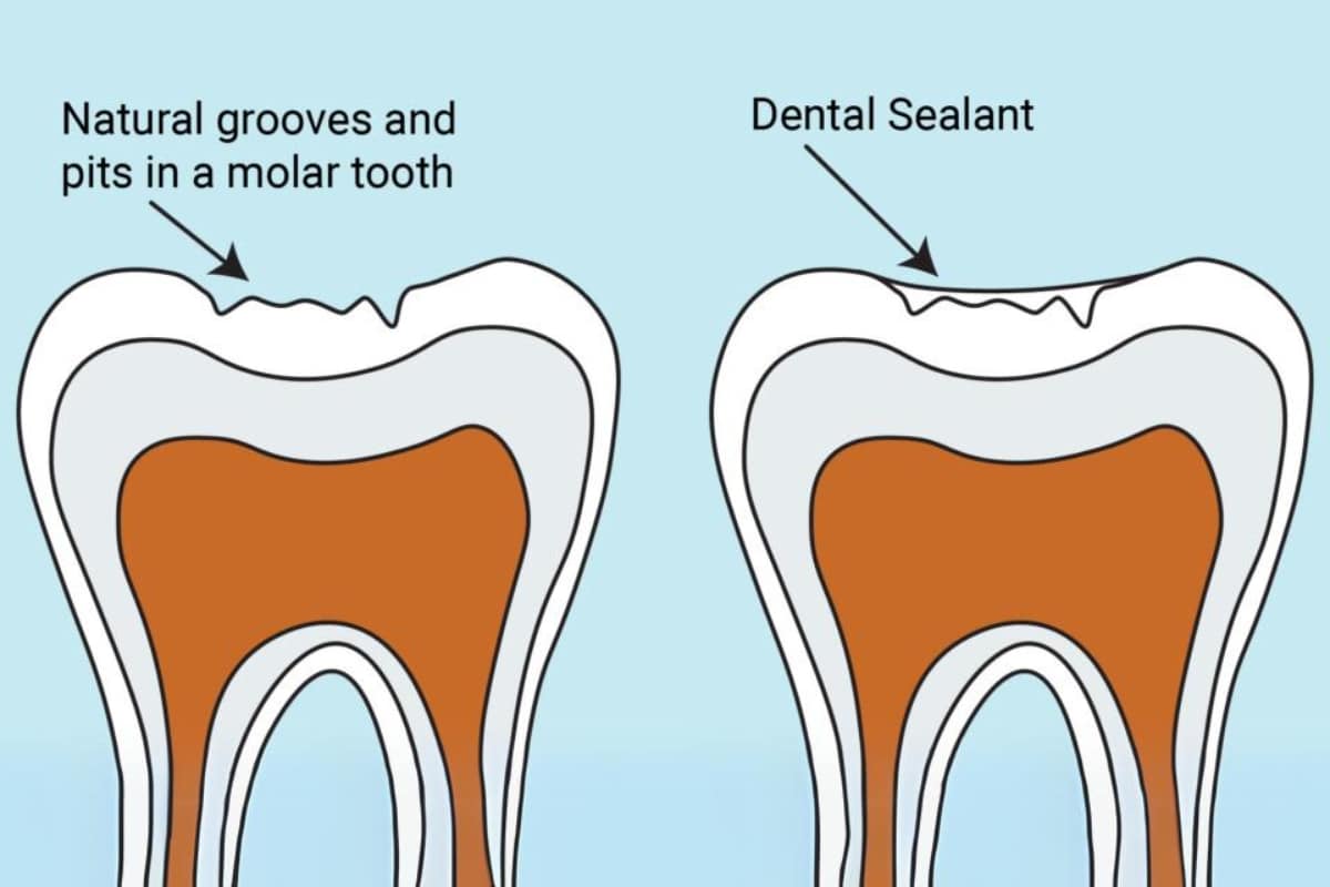 Featured image for “Why Dental Sealants Are Essential for Your Child’s Healthy Teeth”
