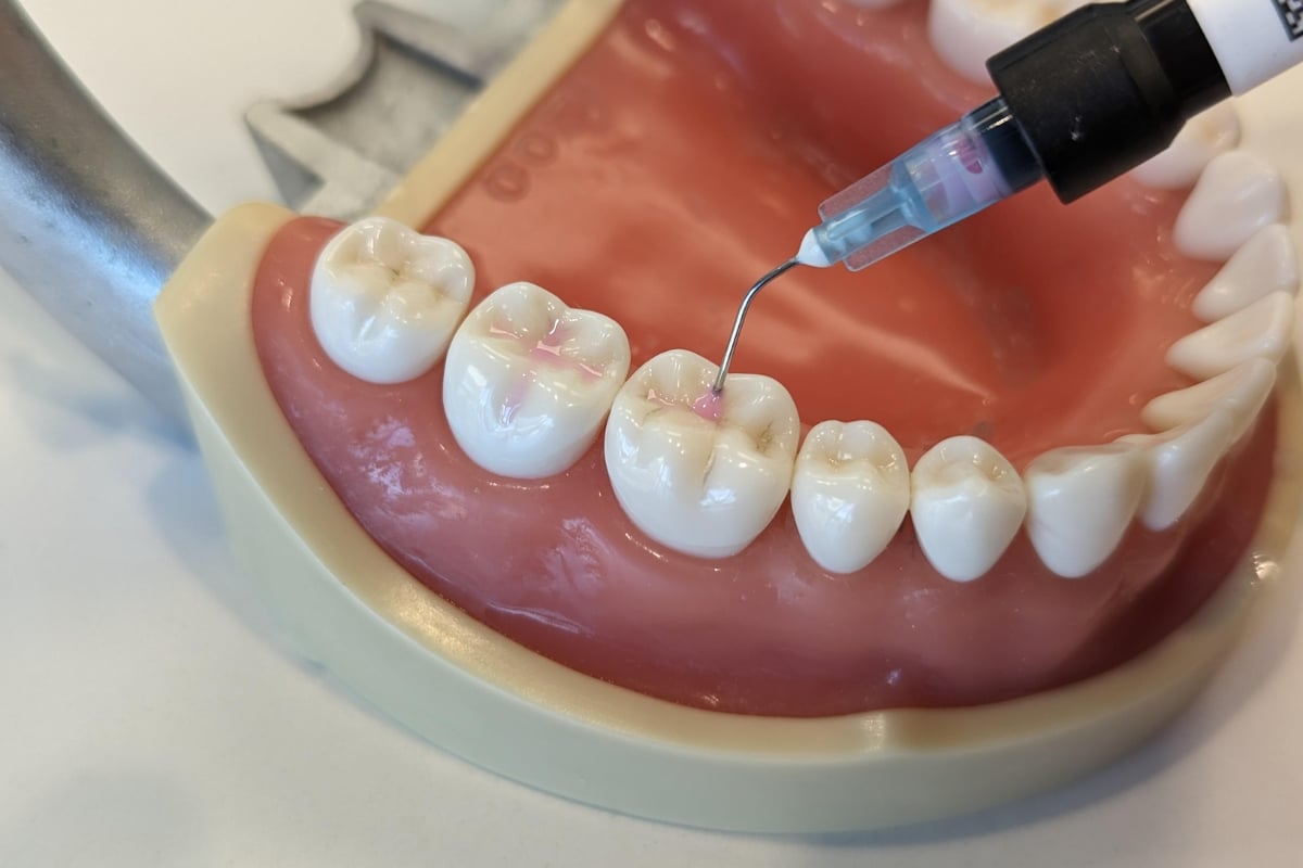 Featured image for “Are Dental Sealants Right For My Child’s Smile”