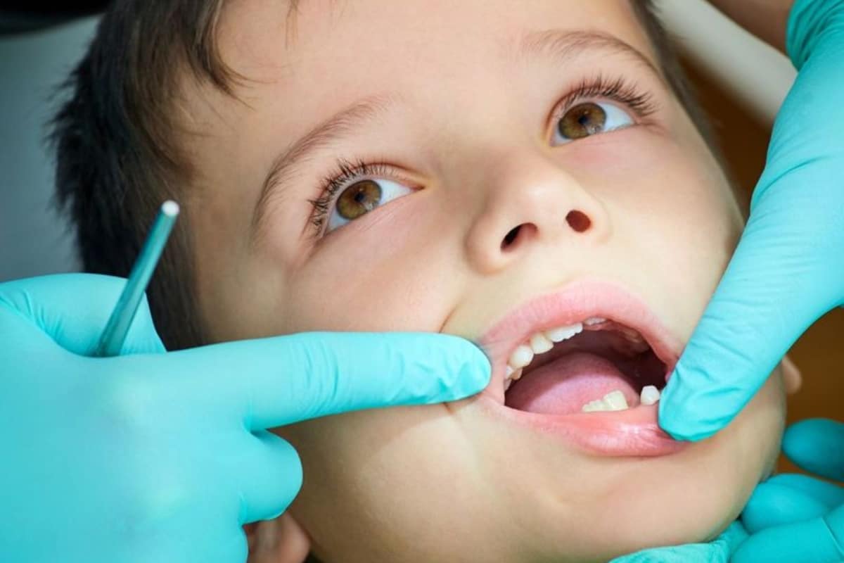 Featured image for “When Should Children Start Visiting the Dentist? A Guide to the Youngest Age for Dental Care”