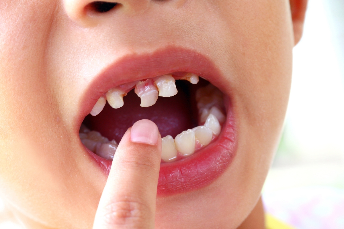 Featured image for “Should You Tighten a Loose Tooth at Home? What Parents Need to Know”
