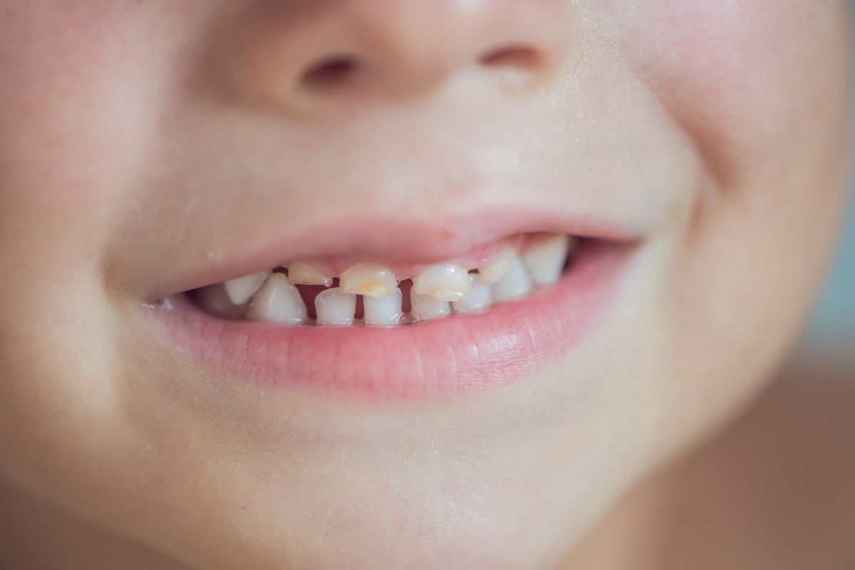 Featured image for “What Makes Baby Teeth More Vulnerable to Decay Than Adult Teeth”