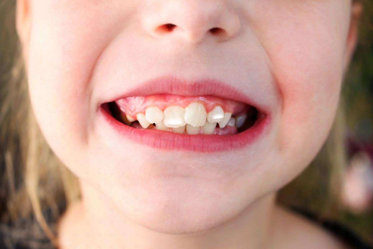 Child showing white spots and discoloration on their front teeth